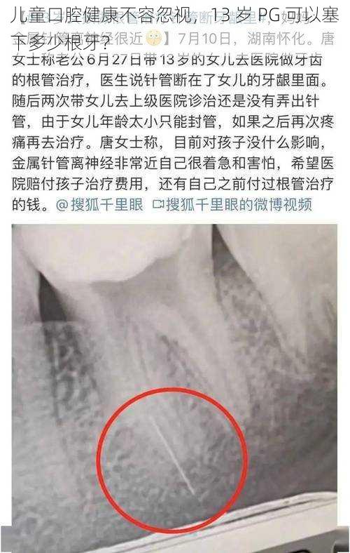 儿童口腔健康不容忽视，13 岁 PG 可以塞下多少根牙？