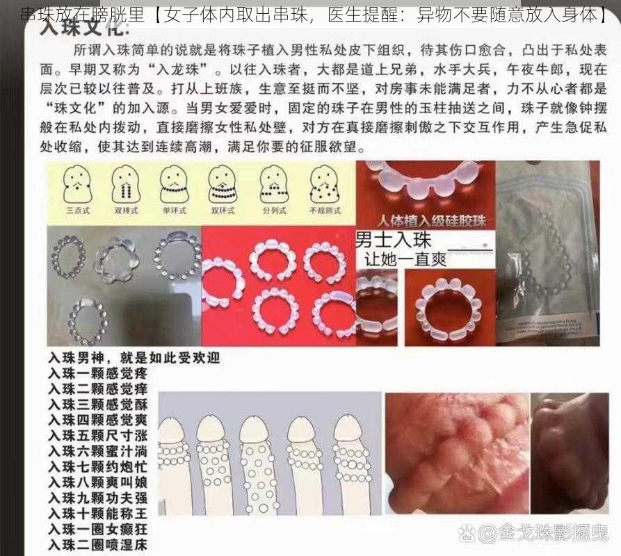 串珠放在膀胱里【女子体内取出串珠，医生提醒：异物不要随意放入身体】